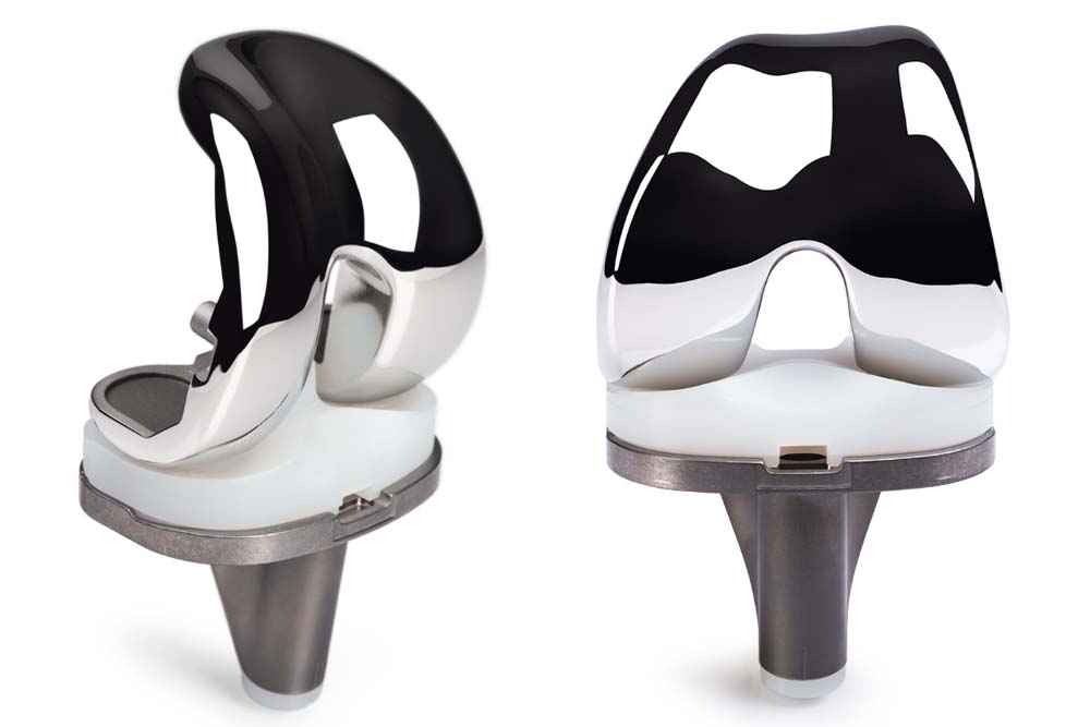 Advanced knee implant prosthesis